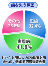 歯周病は歯を失う 原因のナンバーワン