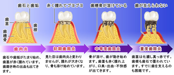 歯周病の進行図